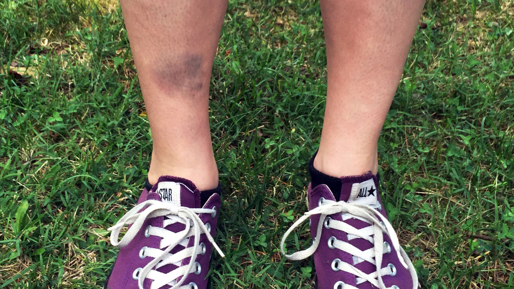 This July 8, 2016, photo provided by Justin Harrison shows the bruised shin of Lindsay Plunkett, a 23-year-old waitress in Asheville, N.C., after she tripped over a cinder block that had been used as a doorstop while playing Pokemon Go, an addictive new game based on cute Nintendo characters like Squirtle and Pikachu. Just days after being made available in the U.S., the mobile game has become the top-grossing app in the App Store. Players have reported wiping out in a variety of ways as they wander the real world - eyes glued to their smartphone screens - in search of digital monsters.(Justin Harrison via AP)