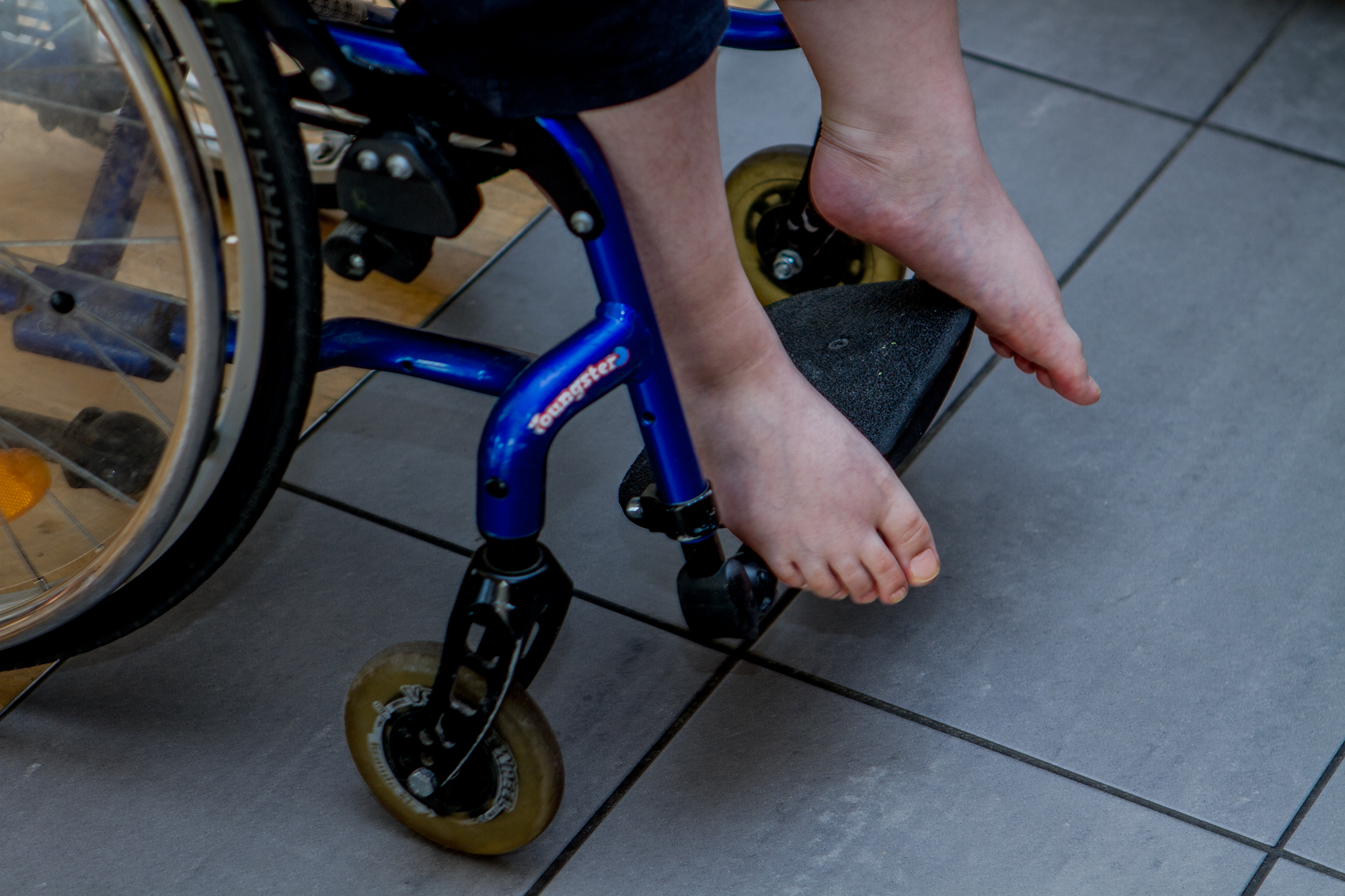 Aufgedunsene Füsse und Beine sind typisch für Duchenne-Patienten.