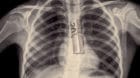 X-ray image of chest
